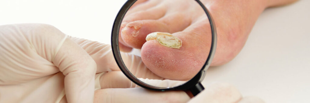 Fungal nail laser treatment at The Hartland Podiatry Clinic in Wantage, Oxfordshire