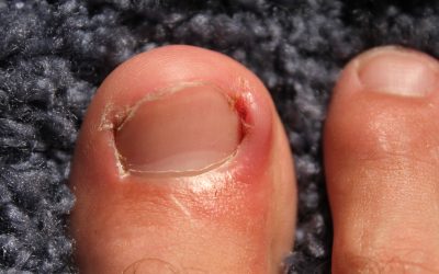 How to Fix Ingrowing Toenails Permanently